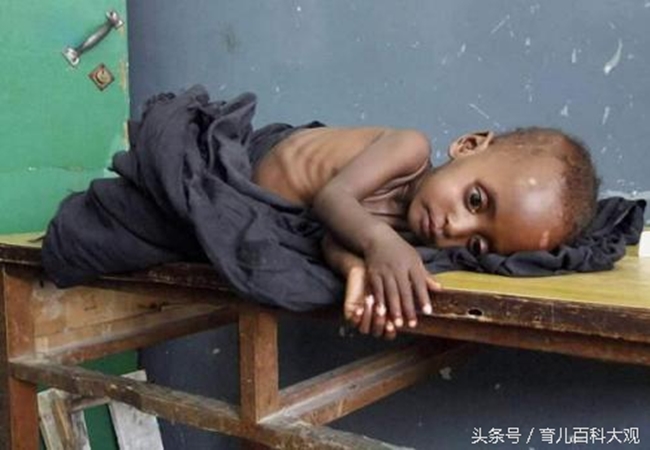 Pity the image of skinny African children because of hunger