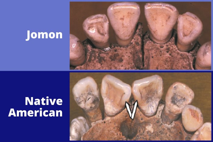 Jomon teeth vs Native American teeth. Credit: G. Richard Scott, University of Nevada Reno