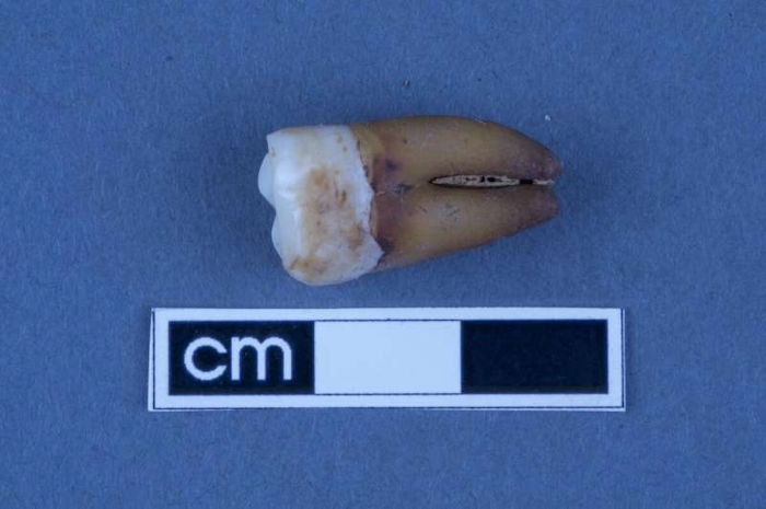 Tooth Analysis Sheds Light On South Australia's Early Colonial History