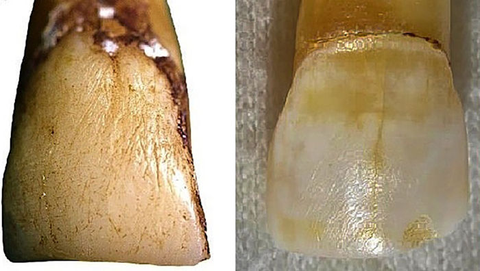 Strange Tooth Raises Unexpected Questions About Human Evolution