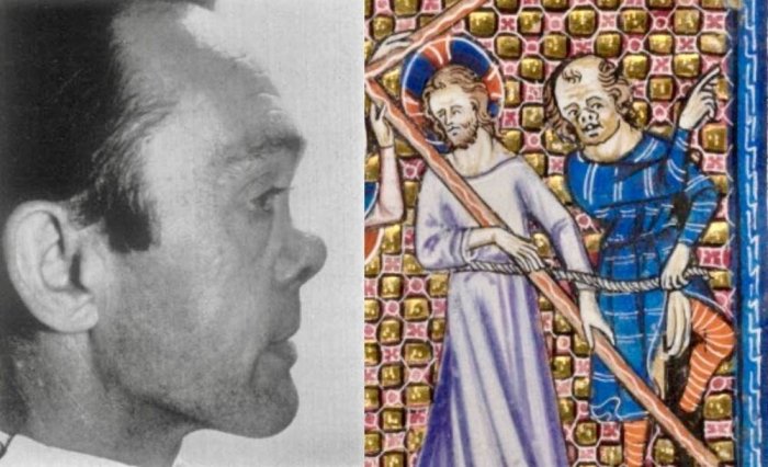 In a medieval painting, one of Christ’s tormentors has facial features reminiscent of a syphilis patient’s saddle nose. Credit: L: British Journal of Plastic Surgery, Vol. 10, McLaren + Penney, The reconstruction of the syphilitic saddle nose: A review of seven cases, Pages 236-252, Copyright 1957–1958. R: The Taymouth Hours, England, mid-14th century. British Library, MS Yates Thompson 13, fol. 120v.